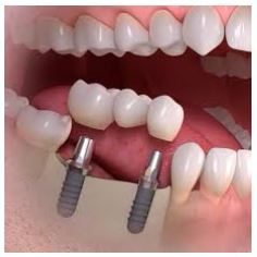imagen de blanqueamiento dental